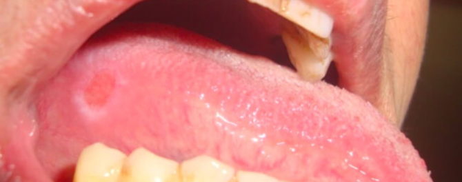 Sår på tungan