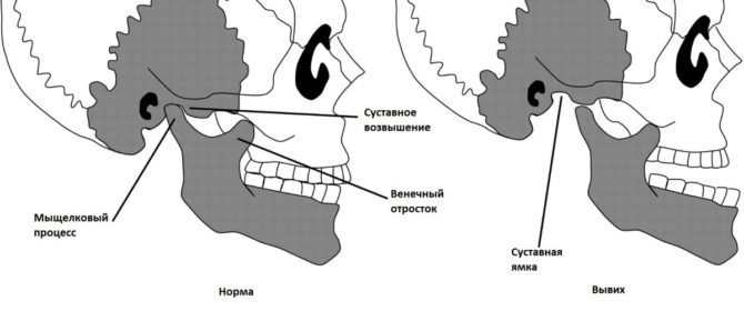 The location of the articular head is normal and with dislocation