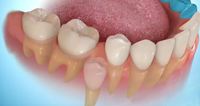 En ny tand vokser i stedet for den fjernede