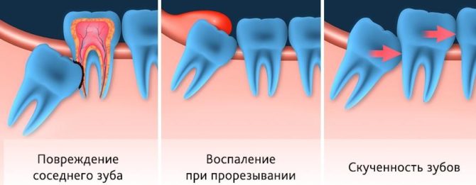 Các loại tăng trưởng răng khôn có vấn đề