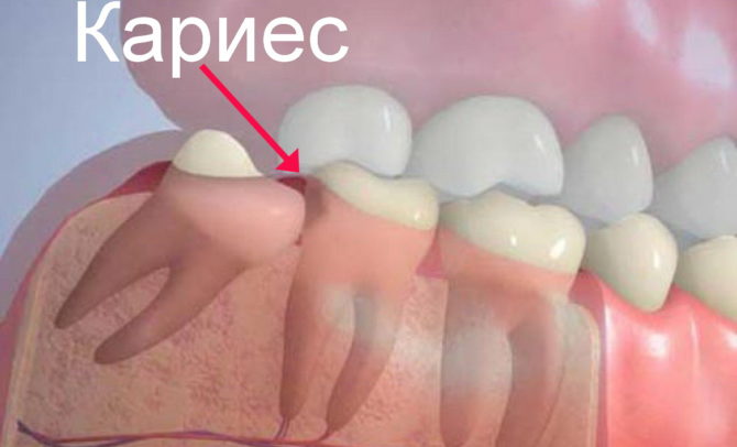 Le développement de caries dans la deuxième molaire en raison d'une dent de sagesse mal éruptée