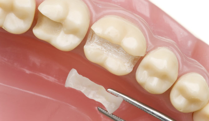 Reconstruction des dents tabulées