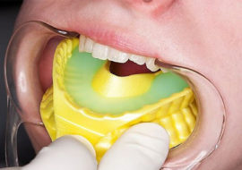 Remineralisierung des Zahnschmelzes mit Kappe
