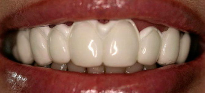 Remineralization של אמייל השיניים