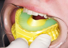 Remineralizzazione dello smalto dei denti
