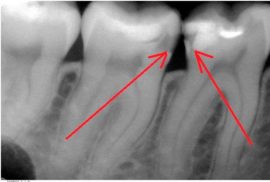 الأشعة السينية للأسنان المسوسة