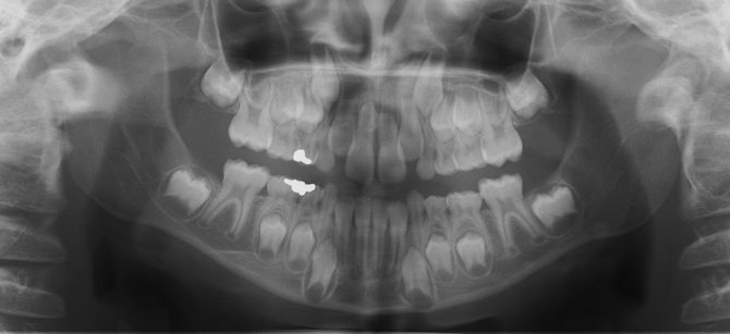 Radiographie des dents de lait et des rudiments de la permanente