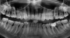 X-ray of teeth with periodontitis