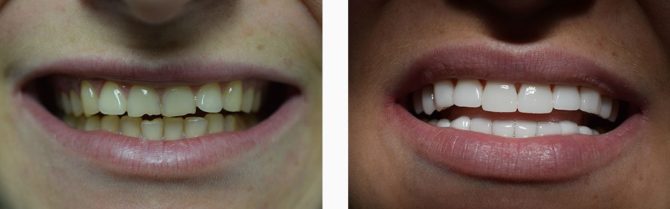 Chipped tooth restoration with veneers