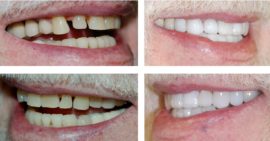 Tooth restoration with lumineers