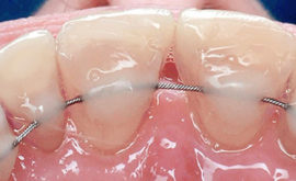Férula de dientes móviles