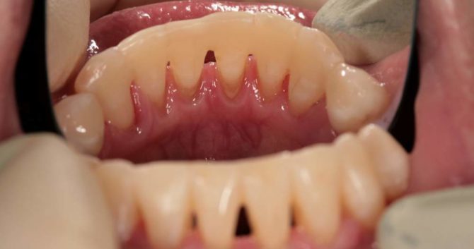Pneumatici sui denti