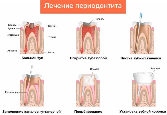 Behandeling met parodontitis