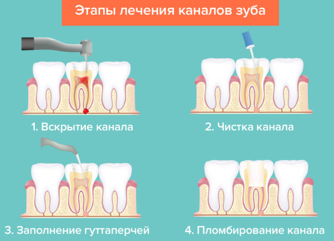Režim liečby zubného kanálika