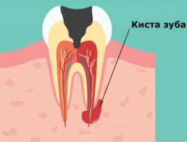O esquema da formação de cistos dentários