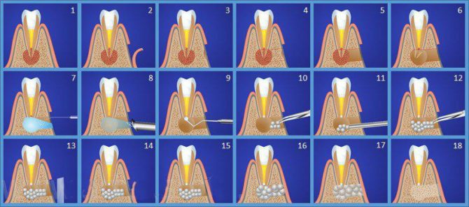 Schema di resezione dell'apice della radice del dente