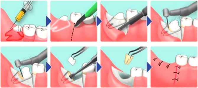 Sudėtinga išminties danties ištraukimo schema