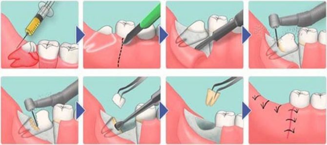 Schéma extrakcie zubov múdrosti