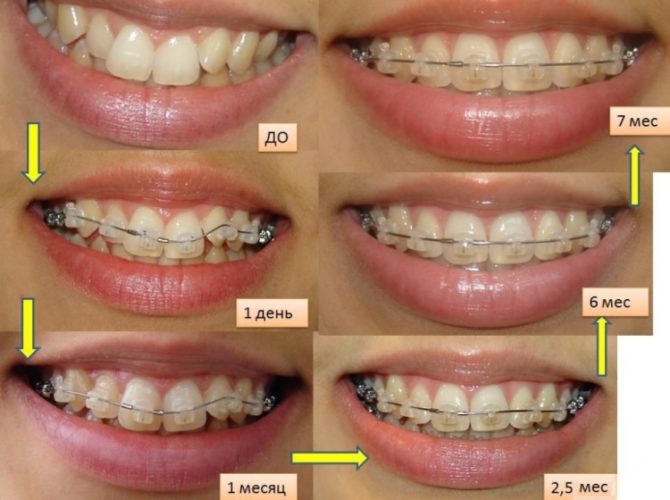 Mga braces ng straightening scheme na may mga braces