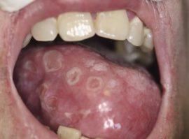 Syphilis dans la langue