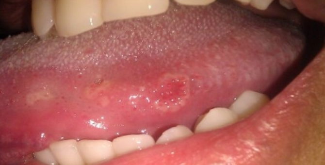 Syphilis dans la bouche