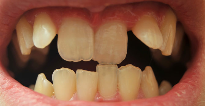 Grave curvatura dei denti