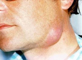 Alvorlig betennelse i submandibulær lymfeknute i nakken