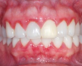 Symtom på tandköttsinflammation