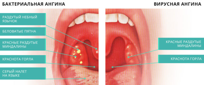 Symptoms of tonsil inflammation