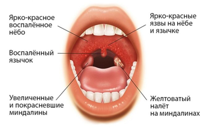 Simptomele unei dureri în gât