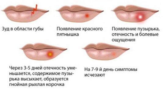Simptomele herpesului