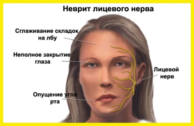 Symptomer på ansiktsneuritt