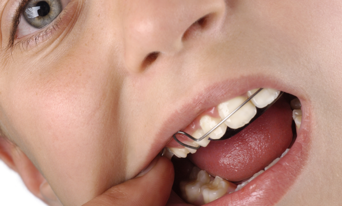 Zahnspange an den Zähnen eines Kindes