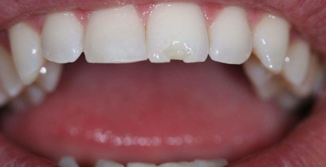 Chipped tooth