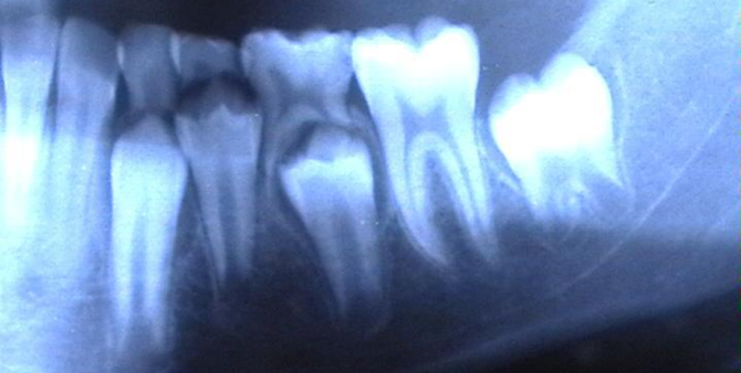 שן חלב קבועה בצילום רנטגן