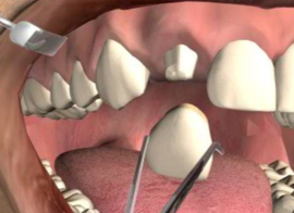 Remoción de corona dental