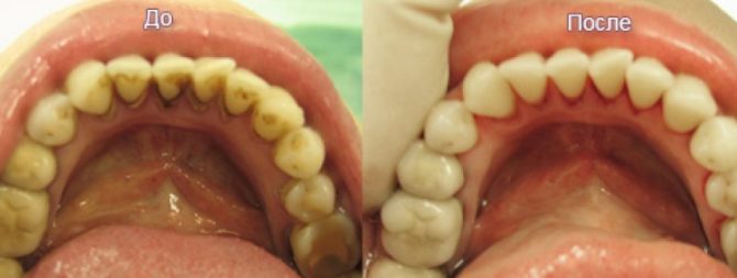 The condition of the teeth before and after the rehabilitation of the oral cavity