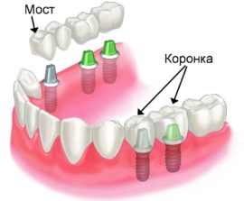 Methods of dental prosthetics using implants
