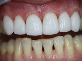 Comparação de dentes naturais e facetas compostas