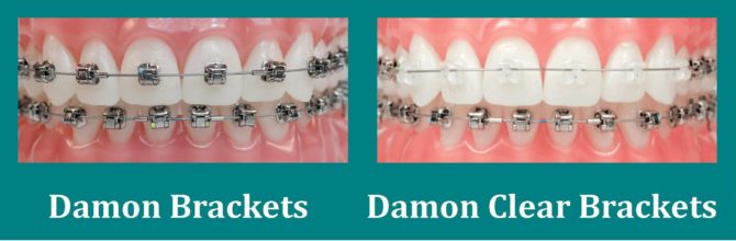 Vergleich von konventionellen Damon und Damon Clear Zahnspangen