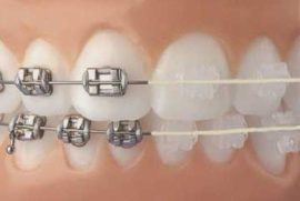 Paghahambing na larawan ng metal at ceramic braces