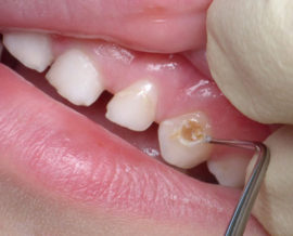 Medium decay of deciduous teeth