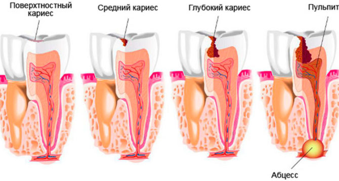 Giai đoạn sâu răng