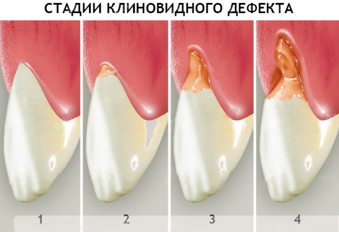 Etapo pleišto formos danties defektas
