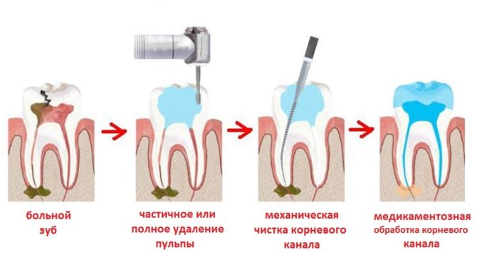 Stadier av tandbehandling för fistlar