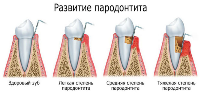 Parodontitis Stadien