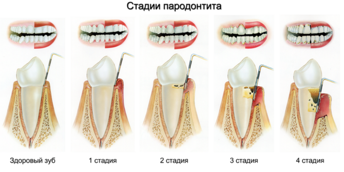 Estágios da periodontite