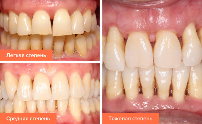 Stadier av periodontal sykdom