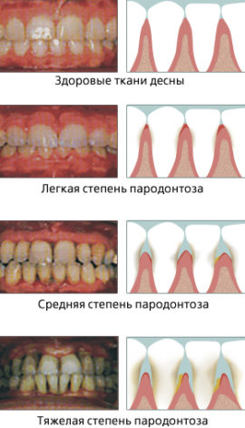 Stades de la maladie parodontale