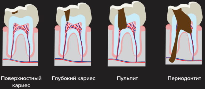 Stadi di carie dentaria